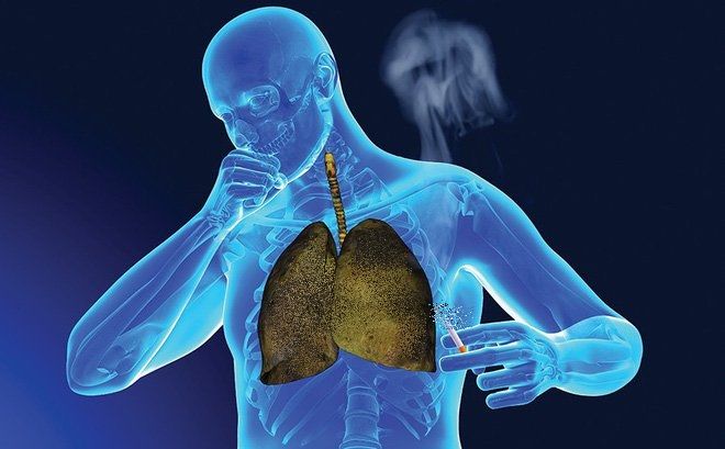 Chỉ cần hút thuốc lá kéo dài 6 tháng là có thể mắc ung thư phổi 