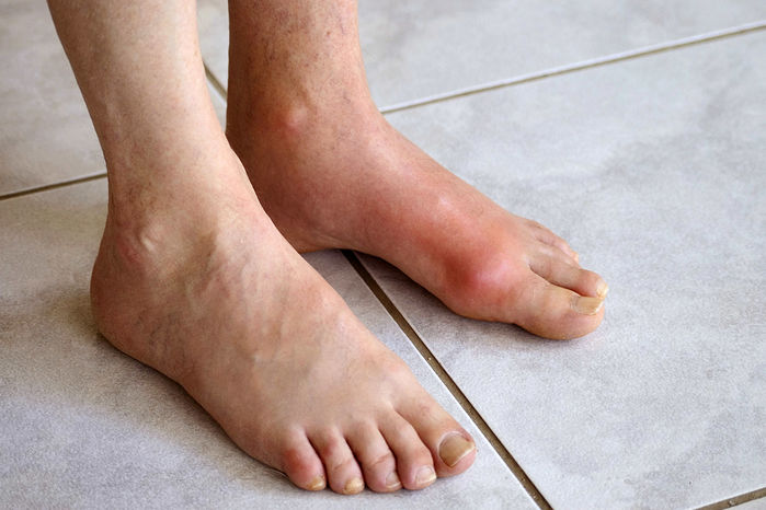 Cô gái 27 tuổi mắc bệnh gout vì ăn lẩu nhiều ngày liên tiếp