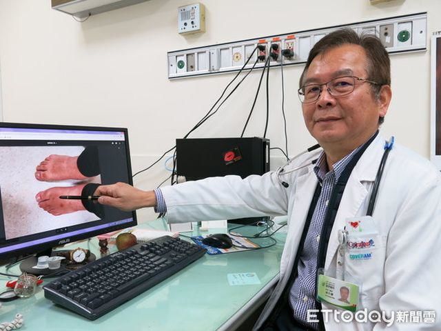 Cô gái 27 tuổi mắc bệnh gout vì ăn lẩu nhiều ngày liên tiếp