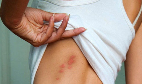 Kinh hãi cô gái bị gián cắn chi chít trên tay vì ở bẩn, lười dọn dẹp