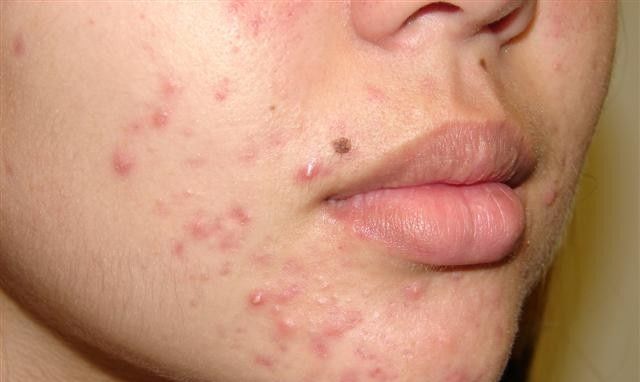 Da mặt cô gái bị tàn phá nặng nề vì sử dụng rượu thuốc để trị mụn
