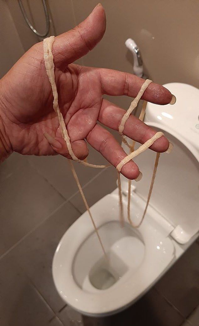 Đang đi vệ sinh, người đàn ông lôi ra con sán dây dài hơn 9m