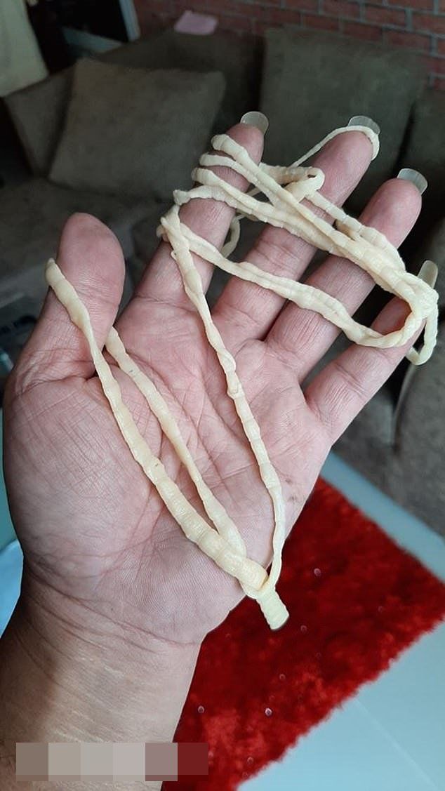 Đang đi vệ sinh, người đàn ông lôi ra con sán dây dài hơn 9m