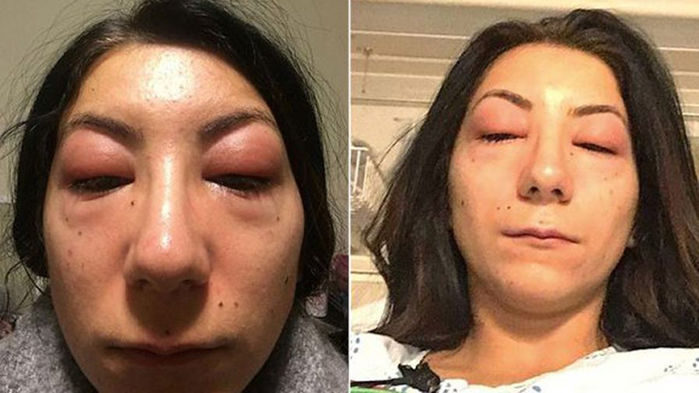 BS Rebecca J. Taylor: Nối mi sai cách dễ sưng đỏ, nhiễm trùng, rụng mi