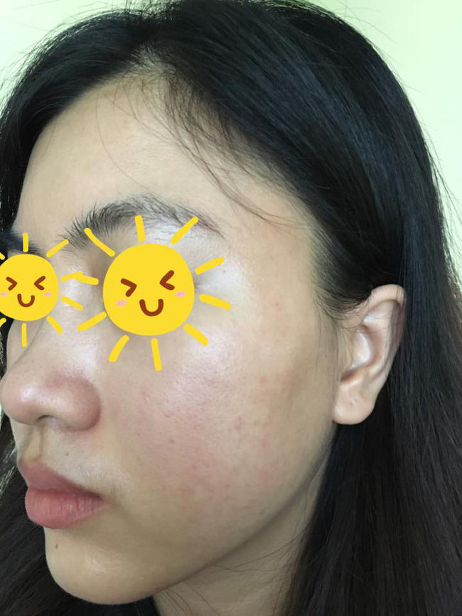 Da mặt cô gái bị tàn phá nặng nề vì sử dụng rượu thuốc để trị mụn
