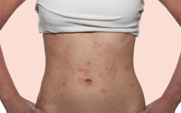 Mặc quần áo sida khiến chị em phái đẹp dễ mắc bệnh phụ khoa