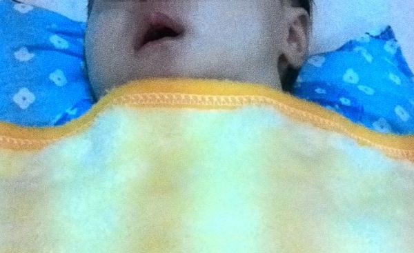 Nuốt phải ngôi sao trang trí Noel, bé gái bị sưng họng, khó thở