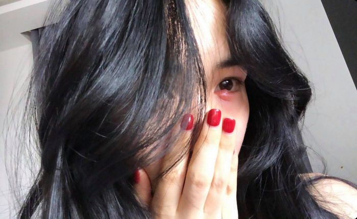 Hòa Minzy bị sưng tấy mắt chỉ vì tẩy trang không đúng cách