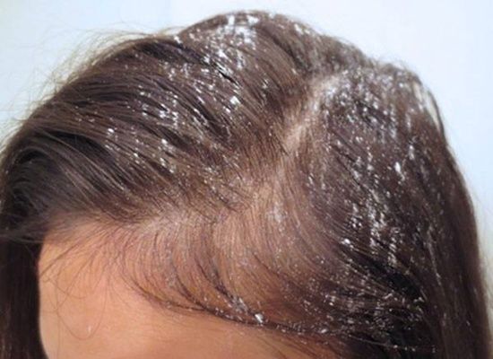 Chỉ cần chanh, bột ngô, phấn rôm... tóc bết mấy cũng sẽ bồng bềnh