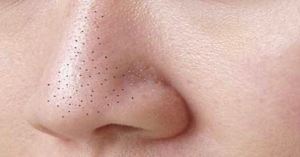 Bác sĩ Nguyễn Đức Long: Không được nặn mụn vùng tam giác tử thần