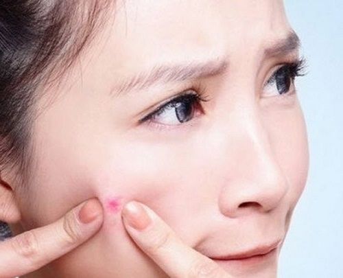 Bác sĩ Nguyễn Đức Long: Không được nặn mụn vùng tam giác tử thần