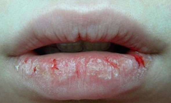 BS BV Da Liễu: Đã có trường hợp ngộ độc chì do son môi hơn 3 lần/ngày
