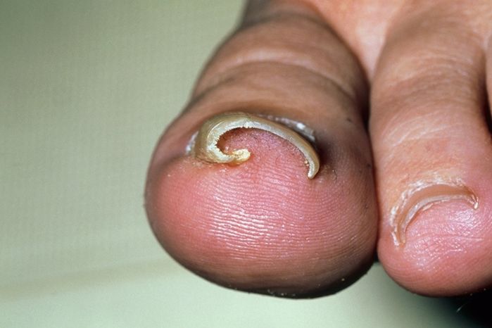 BS. Amesh A. Adalja: Chân bốc mùi và truyền bệnh nếu không tắm kỹ