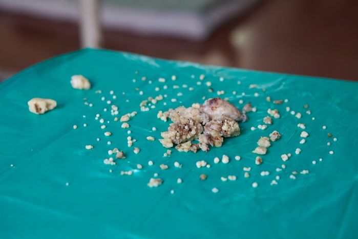Hàng trăm chiếc răng mọc chi chít: Nhổ răng đúng là quá đáng sợ