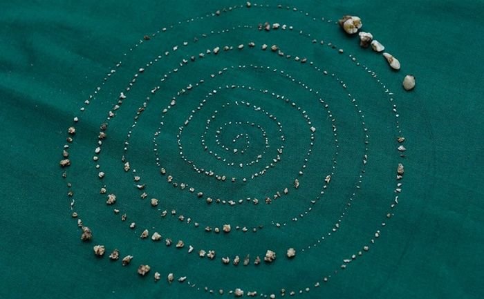 Hàng trăm chiếc răng mọc chi chít: Nhổ răng đúng là quá đáng sợ