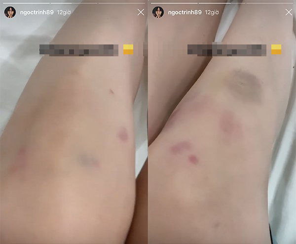 Ngọc Trinh để lộ đôi chân toàn vết thương, bầm tím
