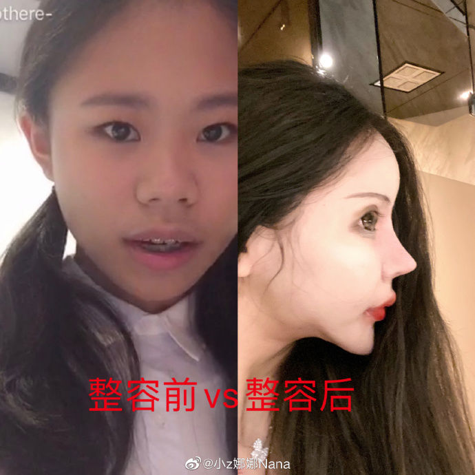 Cô gái Trung Quốc 16 tuổi bị chê là thảm họa mặt rắn vì nghiện dao kéo