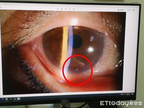 Dùng nước rửa tay khô xong lại dụi mắt, người phụ nữ bị viêm giác mạc