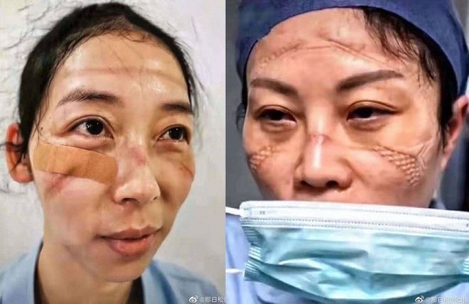 Khuôn mặt đầy vết băng dán của các y bác sĩ chống dịch gây xúc động