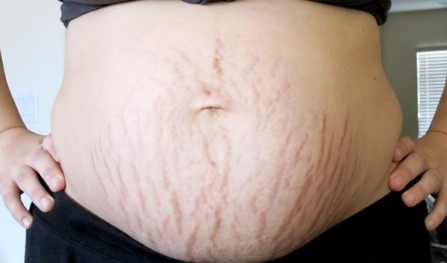 Ly hôn dù mới sinh 6 tháng vì câu nói “cái bụng gớm quá” của chồng