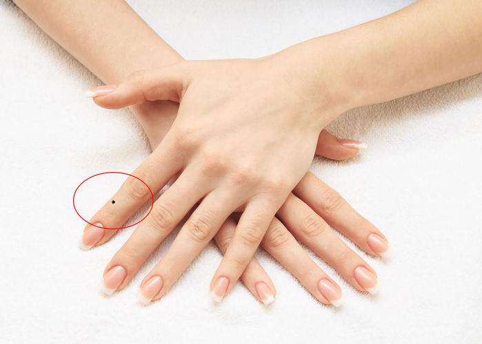 Nốt ruồi ở bàn tay cái có ý nghĩa gì?