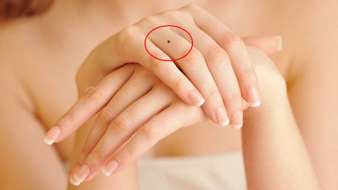 Nốt ruồi ở bàn tay cái có ý nghĩa gì?