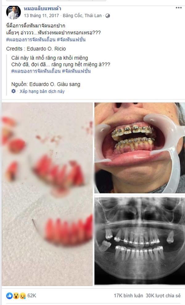 Chưa niềng thì đi một cái, niềng rồi đi luôn cả hàm
