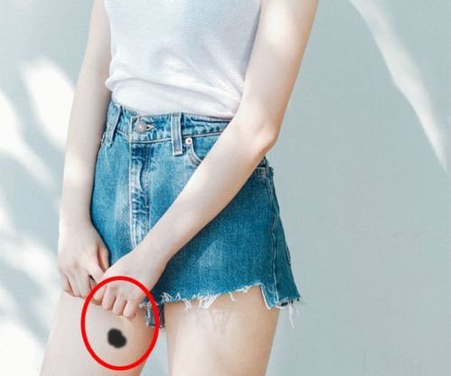 Ý nghĩa của các vết bớt: Ở mông là tốt số, ở chân xui rủi liên miên