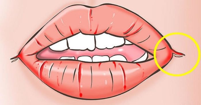 11 mẹo hay cho sức khỏe: Rách khóe môi dùng Vitamin B6