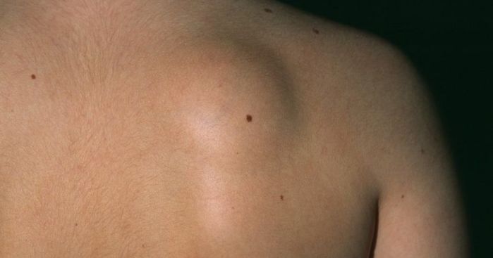 Người đàn ông nổi đầy khối u kỳ dị trên người vì uống nhiều rượu bia
