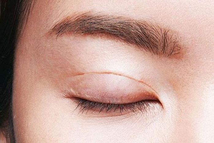 Nỗi khổ hội mắt một mí: Bị trêu ghẹo vì cười không thấy mặt trời