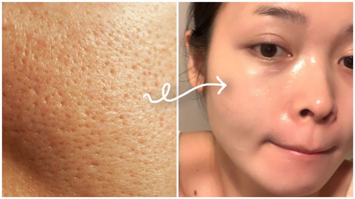 Công cuộc se khít lỗ chân lông sẽ dễ ợt chỉ với 3 sản phẩm “ruột