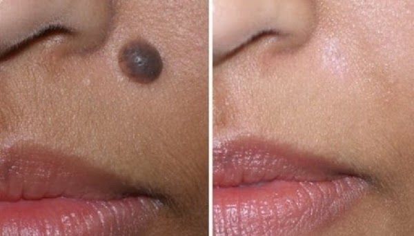 Kinh nghiệm hay: Tẩy nốt ruồi chỉ đơn giản với gừng, tỏi trong nhà bếp