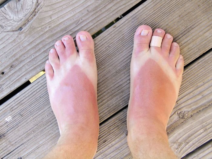 Đi sandal giữa ngày hè đổ lửa làm sao để da chân không loang lổ?