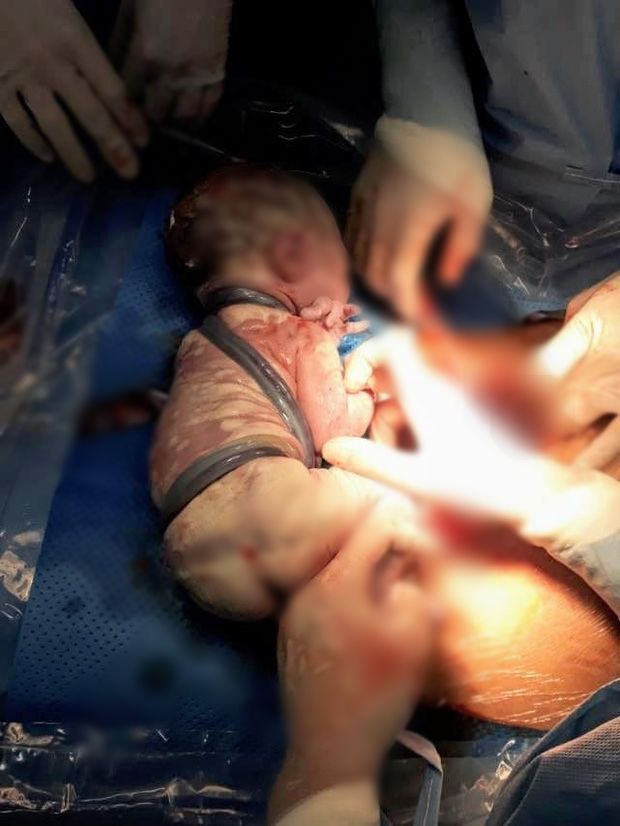 Giải cứu thành công em bé bị dây rốn quấn 6 vòng quanh cơ thể