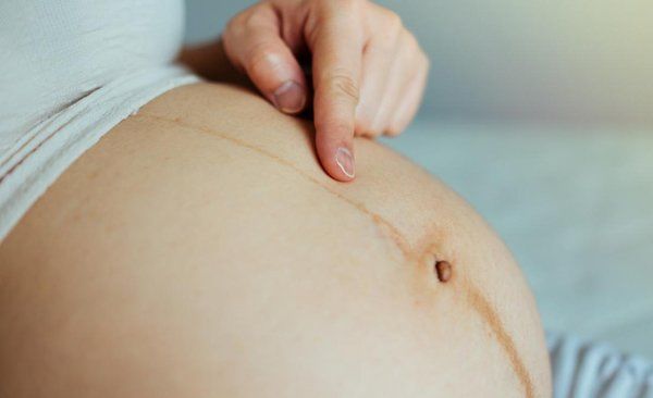 Đường sọc nâu trên bụng mẹ bầu tiết lộ bí mật thai kì, mẹ đừng chê xấu