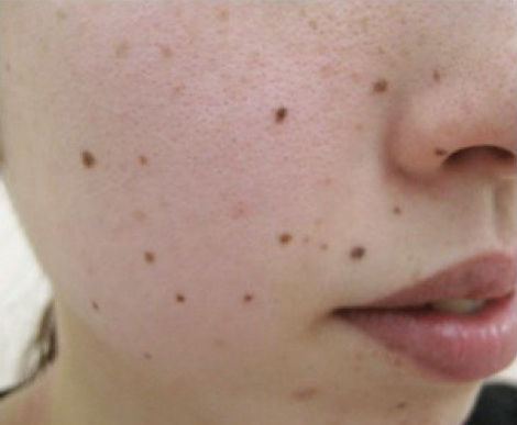 Kinh nghiệm hay: Tẩy nốt ruồi chỉ đơn giản với gừng, tỏi trong nhà bếp