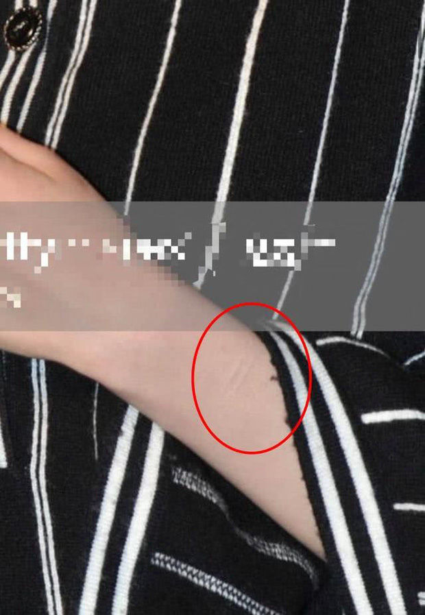 Lộ sẹo trên cổ tay, Dương Mịch vướng nghi vấn ngược đãi bản thân