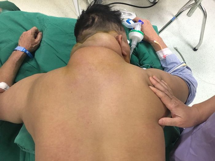 Người đàn ông nổi đầy khối u kỳ dị trên người vì uống nhiều rượu bia