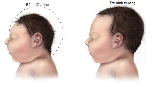 Xuất hiện 1 ca mắc virus Zika, BS cảnh báo ban đầu chỉ sốt nhẹ