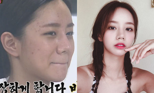 Rời xa son phấn: Seolhyun, Chanyeol da sần sùi lấm tấm mụn