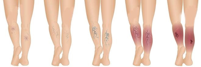 8 lí do khiến tay chân bạn ''gân guốc'', gân xanh nổi rõ dưới da
