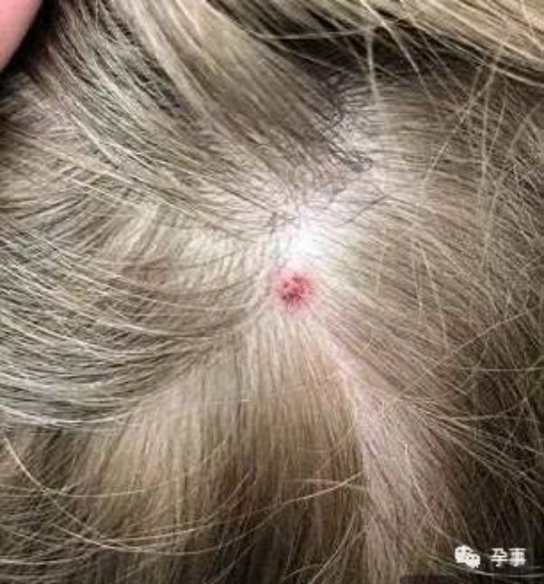 Cảnh giác: Bé gái bị bọ ve cắn, bác sĩ cấp cứu muộn dễ bị ngưng thở
