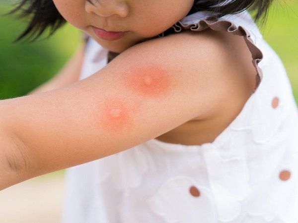 Cảnh giác: Bé gái bị bọ ve cắn, bác sĩ cấp cứu muộn dễ bị ngưng thở