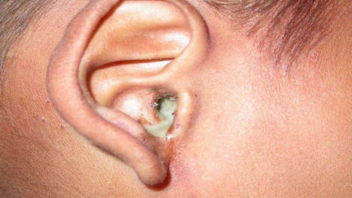 Dấu hiệu nhận biết trẻ có nguy cơ mắc bệnh viêm tai giữa