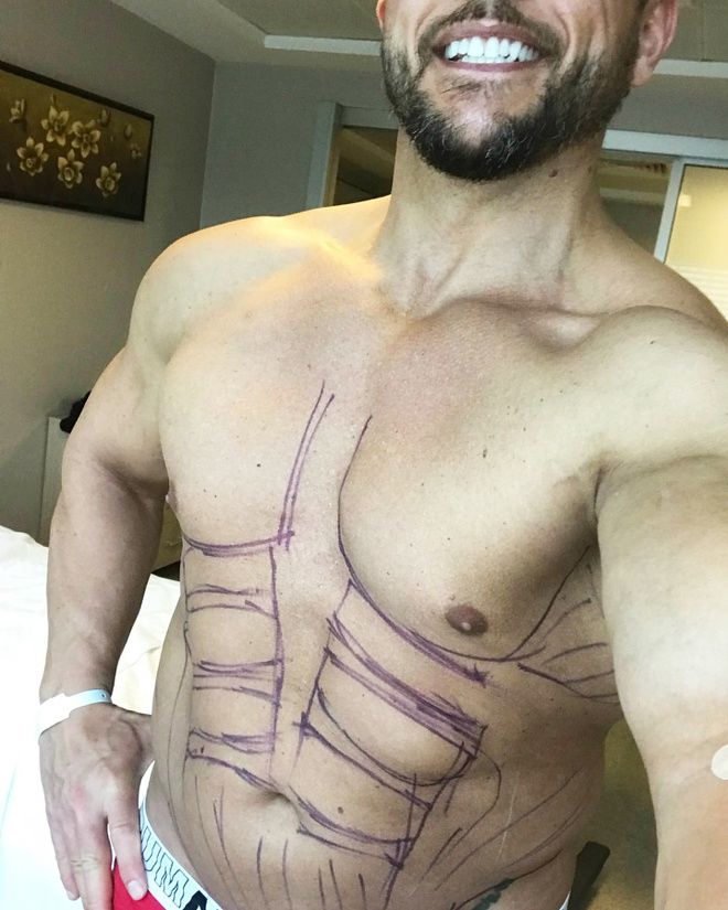 Muốn body vạm vỡ, người đàn ông chi 25.000 USD làm cơ bụng 6 múi giả