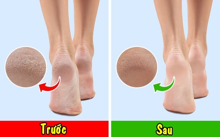 5 lí do bạn nên mang vớ khi ngủ: giúp gót chân nứt nẻ trở nên mịn màng