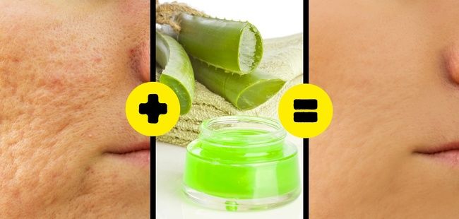 10 cách làm cho sẹo lâu năm ''một đi không trở lại''