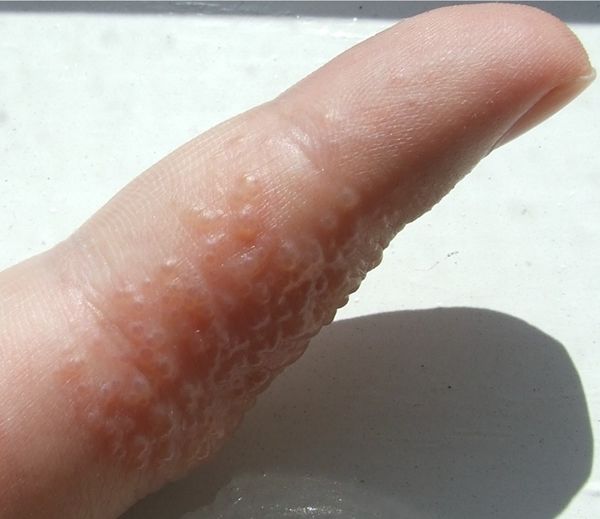 6 nguyên nhân khiến lòng bàn tay của bạn ngứa ran