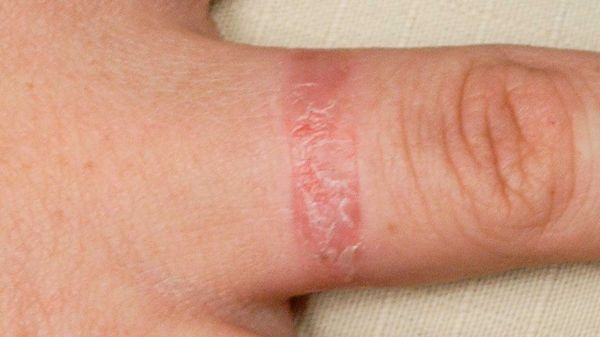 6 nguyên nhân khiến lòng bàn tay của bạn ngứa ran